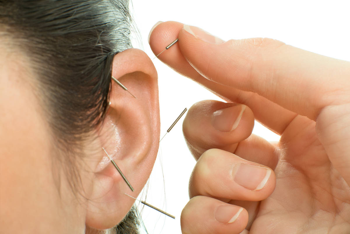 Applicazione di aghi da Agopuntura all’orecchio per smettere di fumare